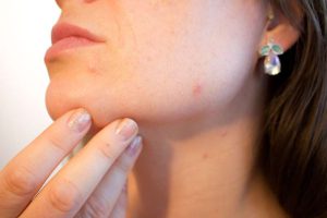 Acne adulta: especialista explica causas e tratamentos