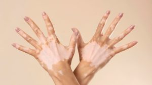 Dia Mundial do Vitiligo conscientiza população sobre a doença