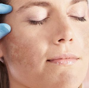 Melasma atinge 35% da população feminina no Brasil