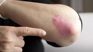 Dia Mundial da Psoríase – dermatologia integrativa atua como grande aliada no combate à doença