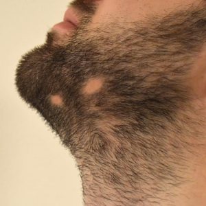 Alopecia aerata na barba saiba como tratar e prevenir