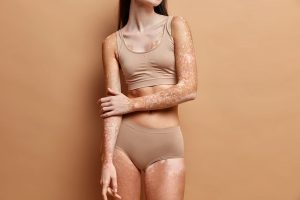 Vitiligo: dermatologista esclarece dúvidas sobre doença que atinge mais de um milhão de pessoas no Brasil