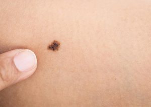 Dia Mundial de Combate ao Câncer: dermatologista explica fatores que podem levar à doença e fala sobre prevenção