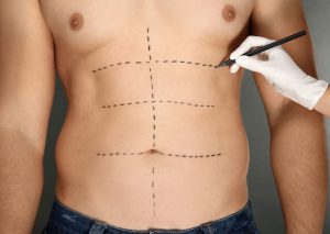 Pesquisa revela que a lipoaspiração é a cirurgia plástica mais popular no Brasil