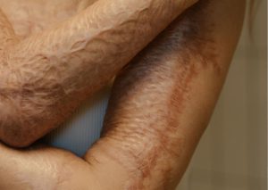 Junho Laranja: campanha alerta sobre a conscientização e prevenção de queimaduras