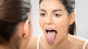 Língua branca: Especialista explica quais são as causas da saburra lingual