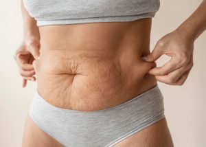 Lipedema: Conheça a condição confundida com obesidade que afeta 12,3% das  mulheres brasileiras