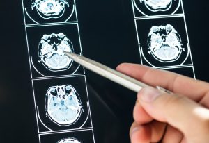 Aneurisma cerebral: ameaça silenciosa que pode levar a óbito
