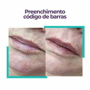 Rugas periorais: saiba como tratar o código de barras