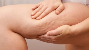 Especialista explica a diferença entre lipedema e celulite