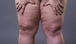 Lipedema: entenda como a doença atinge quase que exclusivamente mulheres