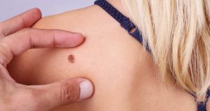 Dia Mundial de Combate ao Câncer: especialista detalha sinais de alerta e estimula prevenção contra o problema