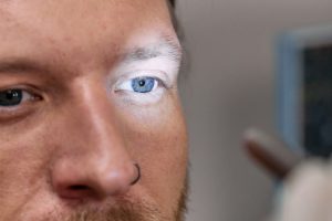 Glaucoma: um perigo silencioso que requer tratamento contínuo