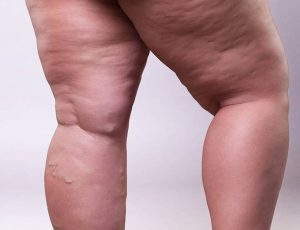 Junho é o mês dedicado à conscientização sobre o lipedema