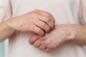 Dermatologista alerta sobre como prevenir doenças de pele comuns no verão