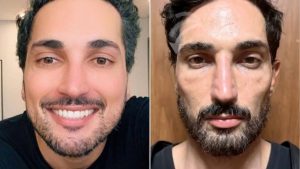 Antes e depois de influencer após uso de caneta emagrecedora choca internautas e levanta reflexão sobre flacidez facial